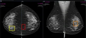 Women pay for AI to boost mammogram findings