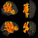 World first: Researchers identify specific regions of the brain that are damaged by high blood pressure and are involved in a decline in mental processes and dementia