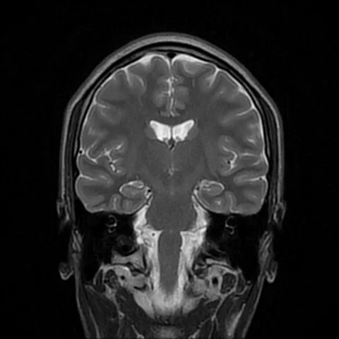 A coronal T2-weighted MRI image of a human brain