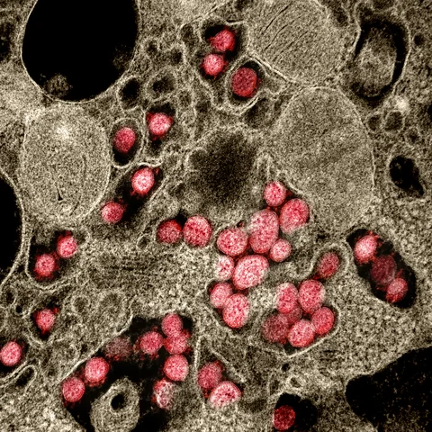 Colour-enhanced electron micrograph of SARS-CoV-2 particles